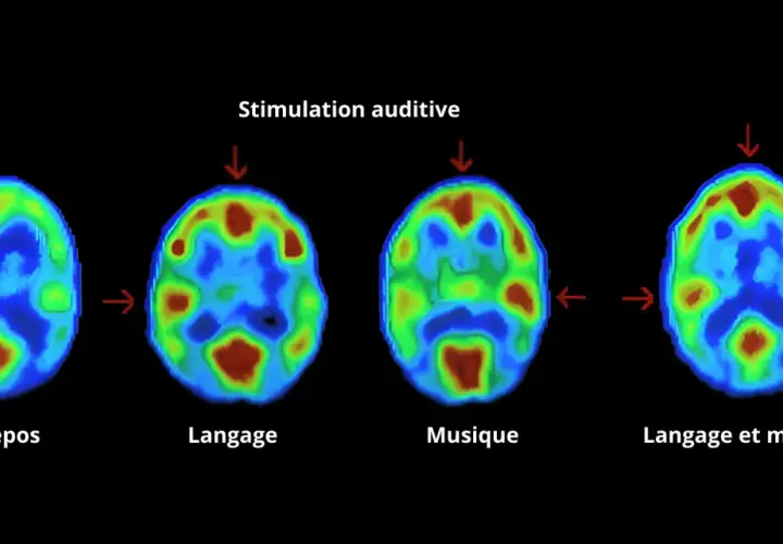 Imagerie cérébrale montrant l'activité lors du repos, du langage, de la musique et des deux. La musique révèle une zone sensible en musique.