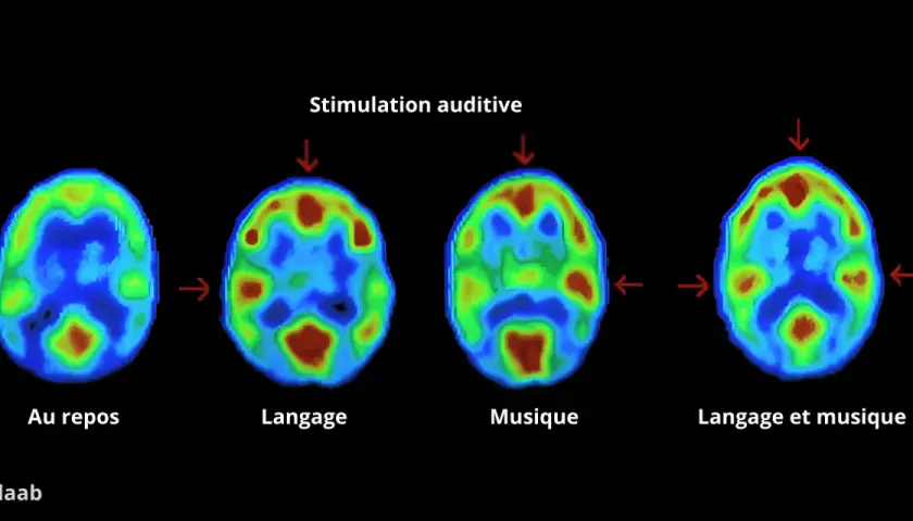 Imagerie cérébrale montrant l'activité lors du repos, du langage, de la musique et des deux. La musique révèle une zone sensible en musique.